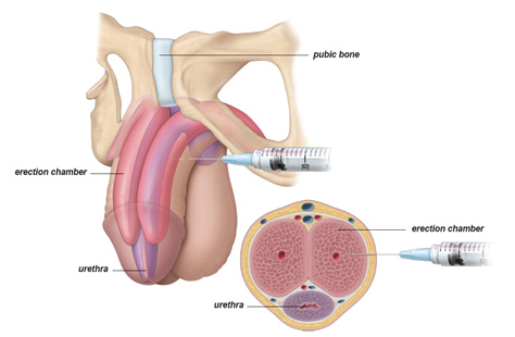 Penile Alprostadil Injection - KM NU Hospitals