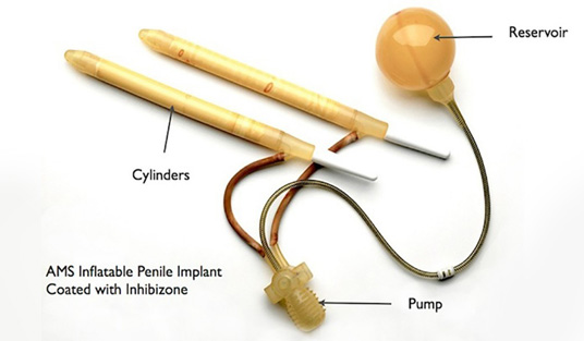 penile Implant - KM NU Hospitals