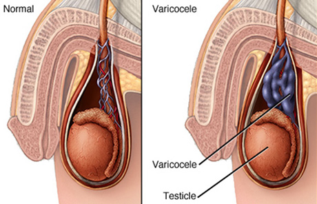 Varicocele