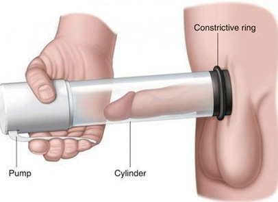 Vacuum erection device - KM NU Hospitals