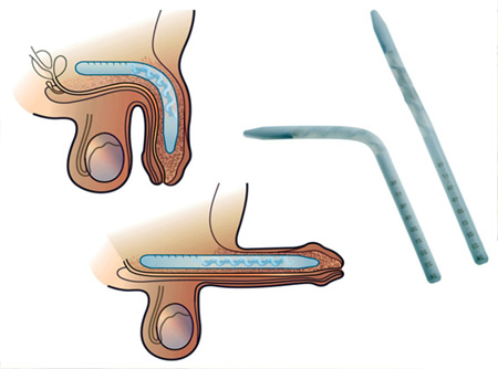 Treatment for Erection Problems - KM NU Hospitals