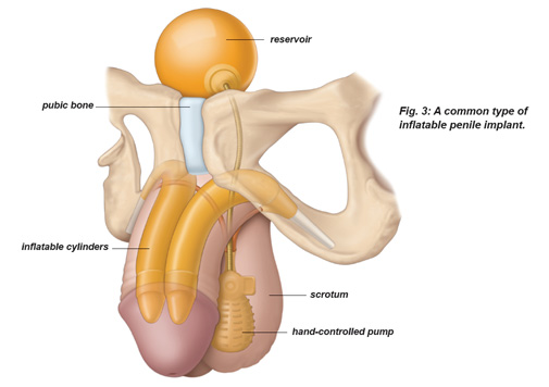 Inflatable penile Implant - KM NU Hospitals